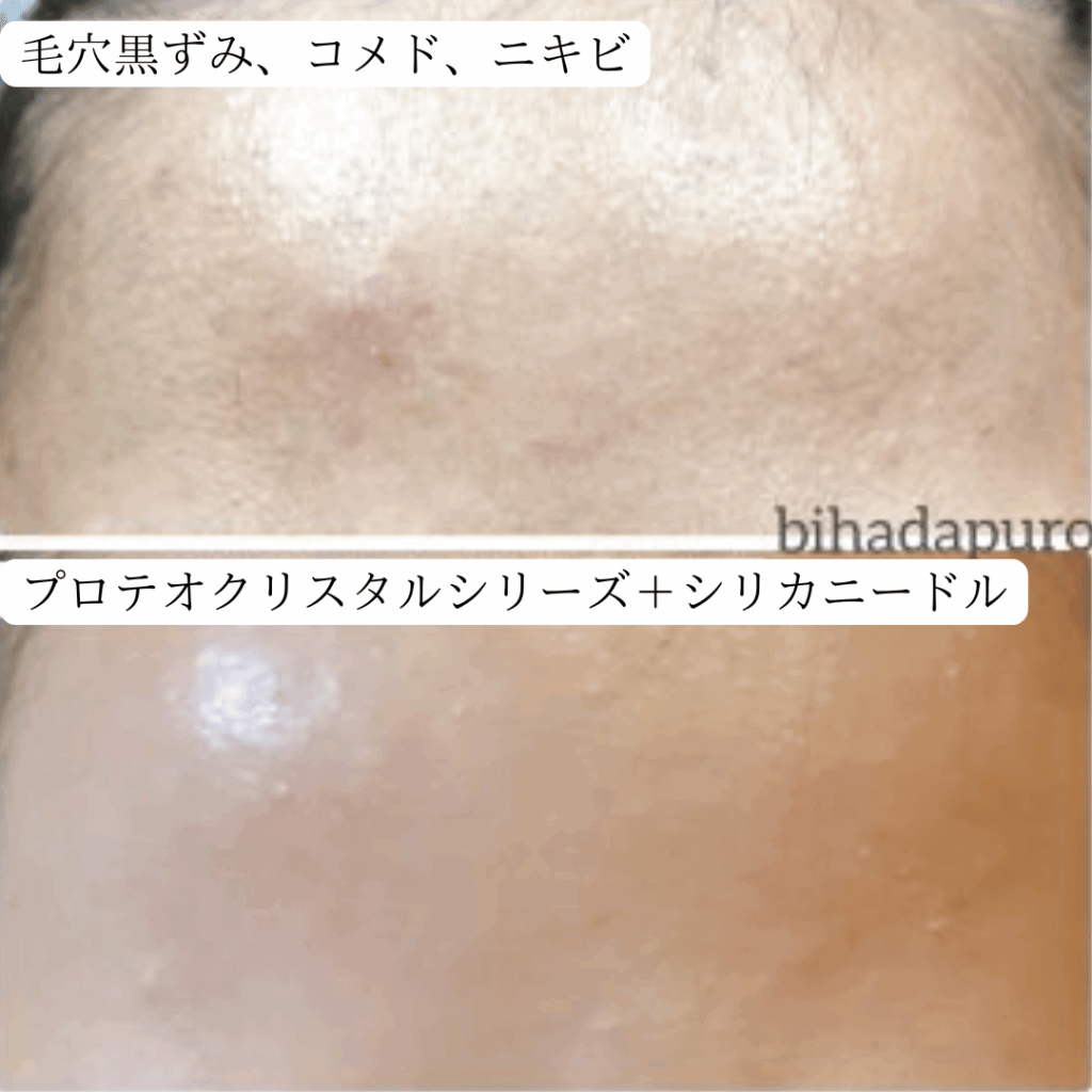 毛穴の黒ずみ、コメド―ニキビなどをケアした