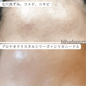 毛穴の黒ずみ、コメド―ニキビなどをケアした