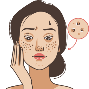 頬の毛穴黒ずみイメージ