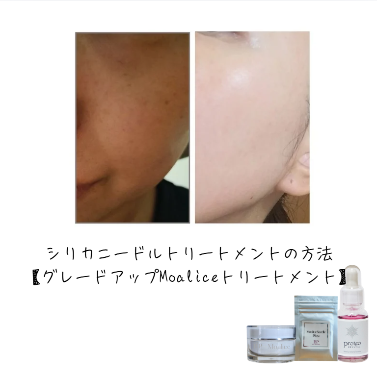 silica-needle-moalice-howto.png