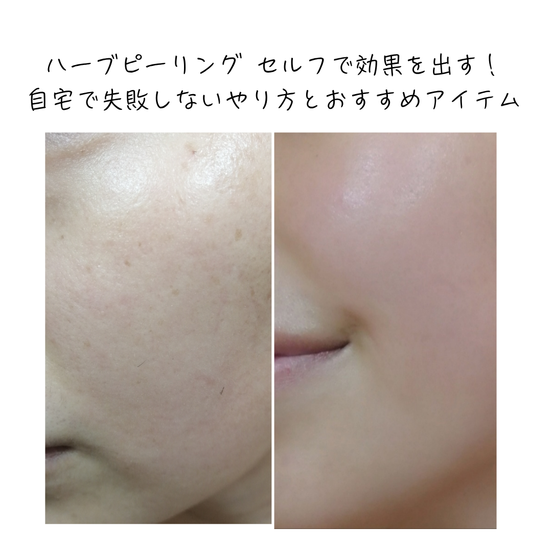最新版】ハーブピーリング セルフで効果を出す！自宅で失敗