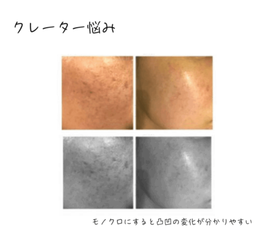 ニキビボコボコに悩む人の比較写真スピキュールトリートメント：クレーター肌