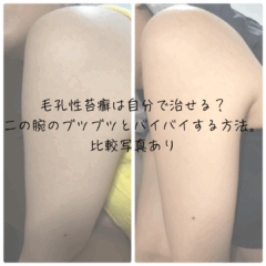毛孔性苔癬は自分でケアできる？二の腕のブツブツとバイバイする方法。比較写真あり