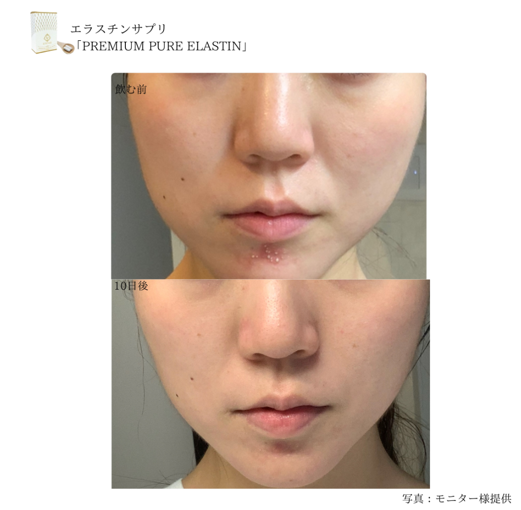 プレミアムピュアエラスチンサプリ10日飲んだモニター写真