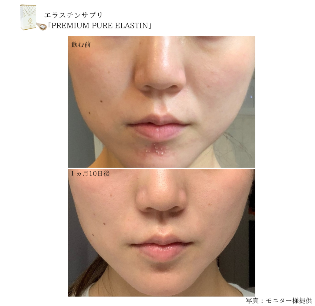 プレミアムピュアエラスチンサプリモニター様の写真