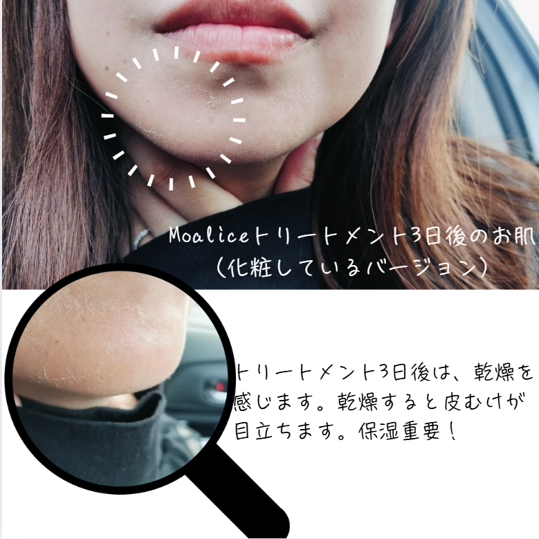 Moaliceトリートメントをして3日後の状態。