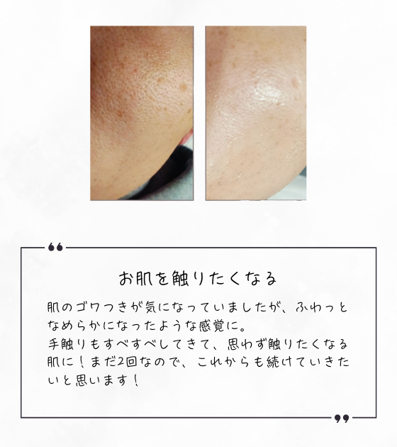 男性:セルフスピキュールケア「Moaliceトリートメント」の比較写真と感想