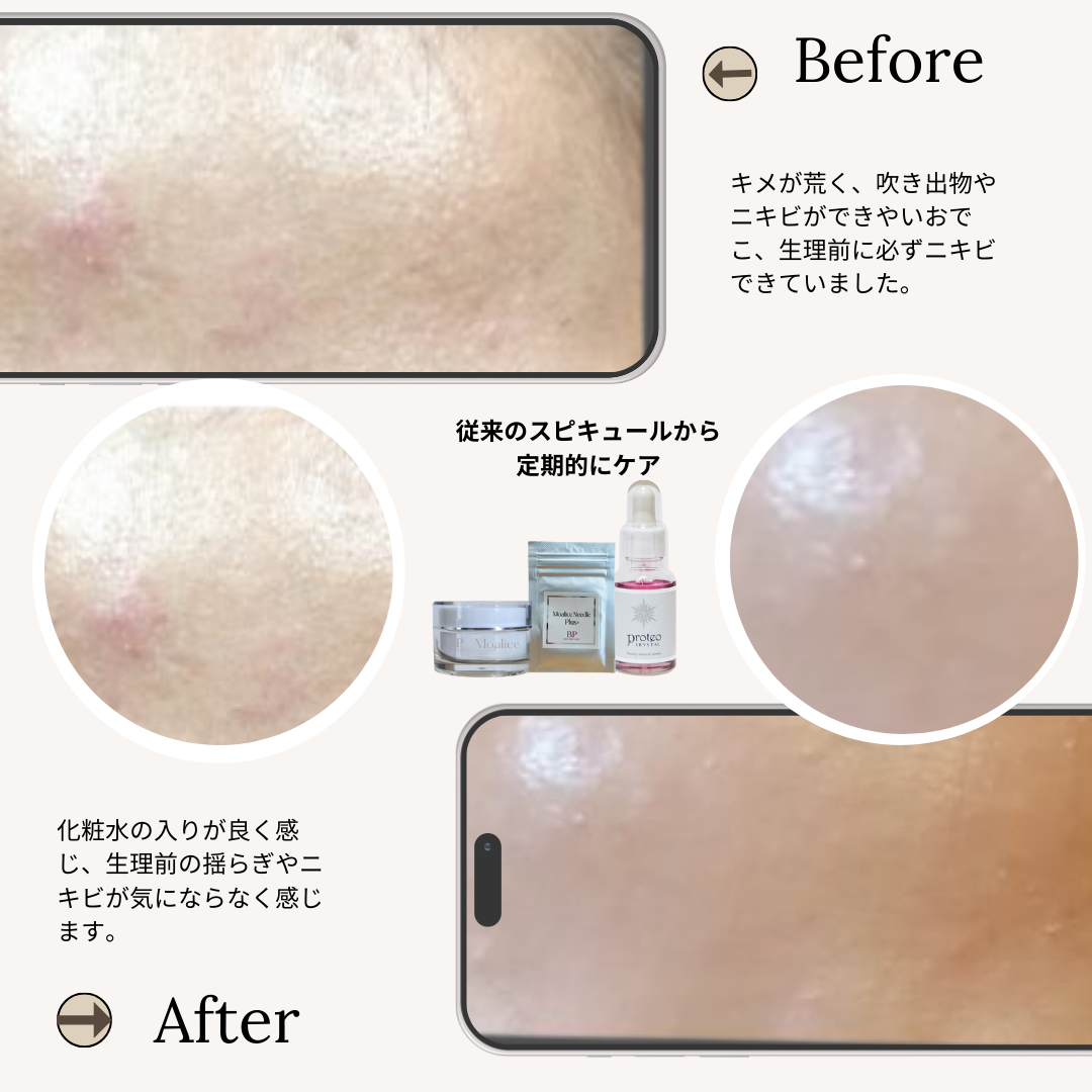 bihadapuroショップのスピキュールケアをセルフでした方のビフォーアフター