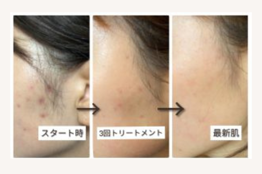 bihadapuroショップのスピキュールケアをセルフでした方のビフォーアフター