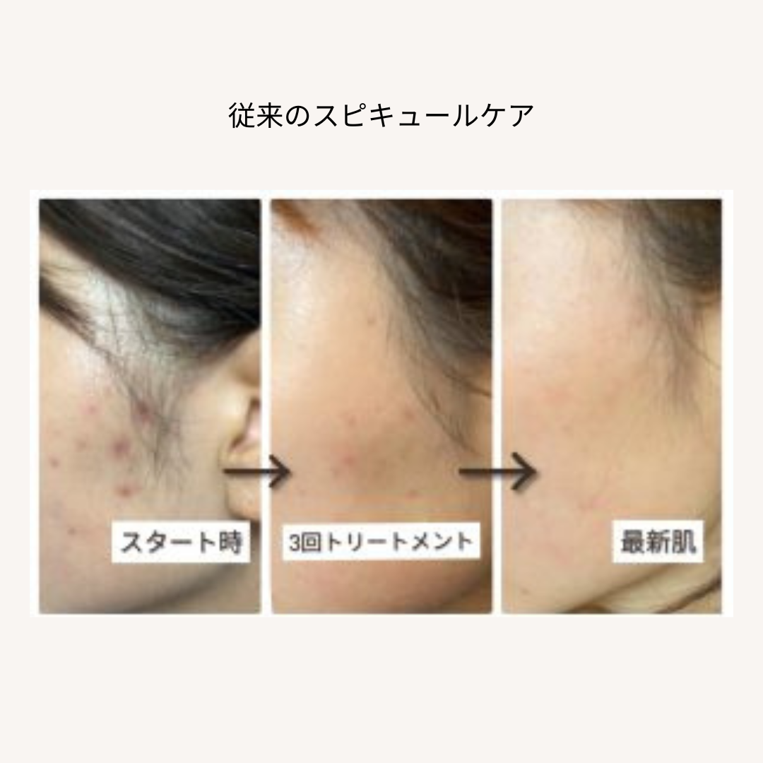bihadapuroショップのスピキュールケアをセルフでした方のビフォーアフター