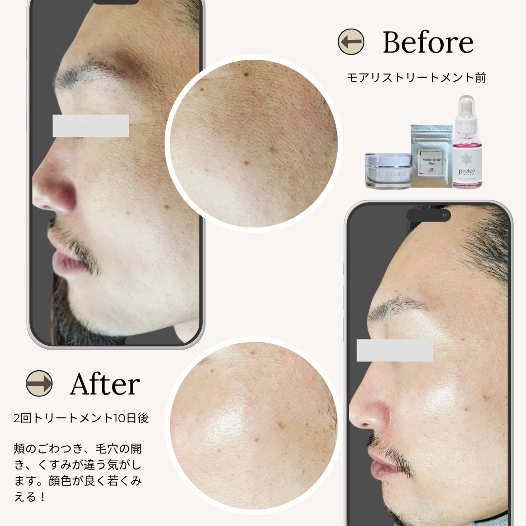 bihadapuroショップのスピキュールケアをセルフでした方のビフォーアフター