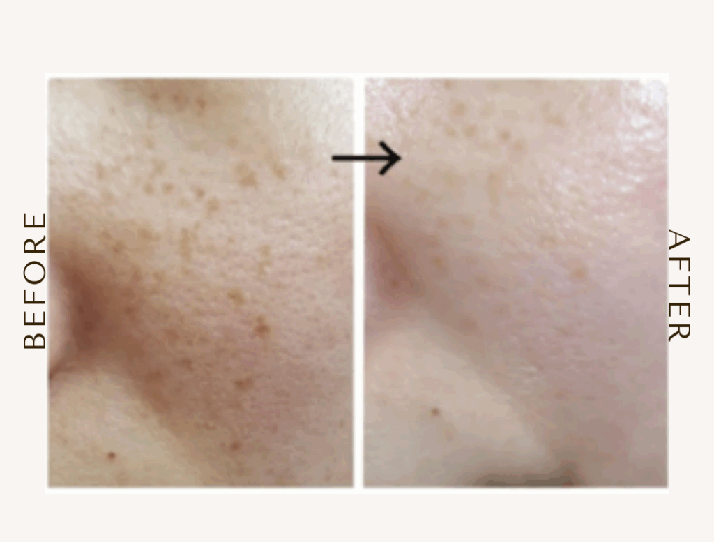 bihadapuroショップのスピキュールケアをセルフでした方のビフォーアフター