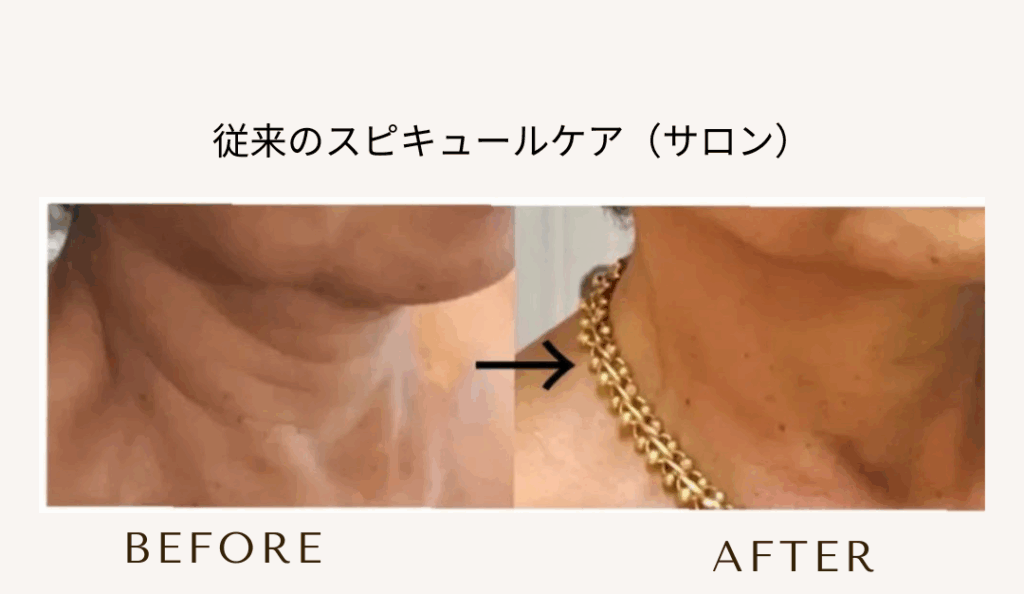 bihadapuroショップのスピキュールケアをセルフでした方のビフォーアフター