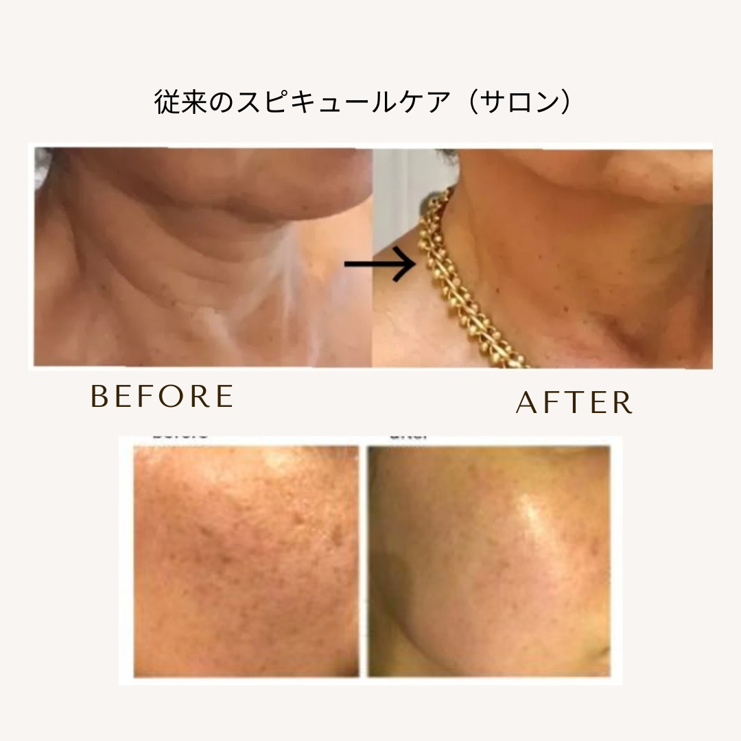 bihadapuroショップのスピキュールケアをセルフでした方のビフォーアフター