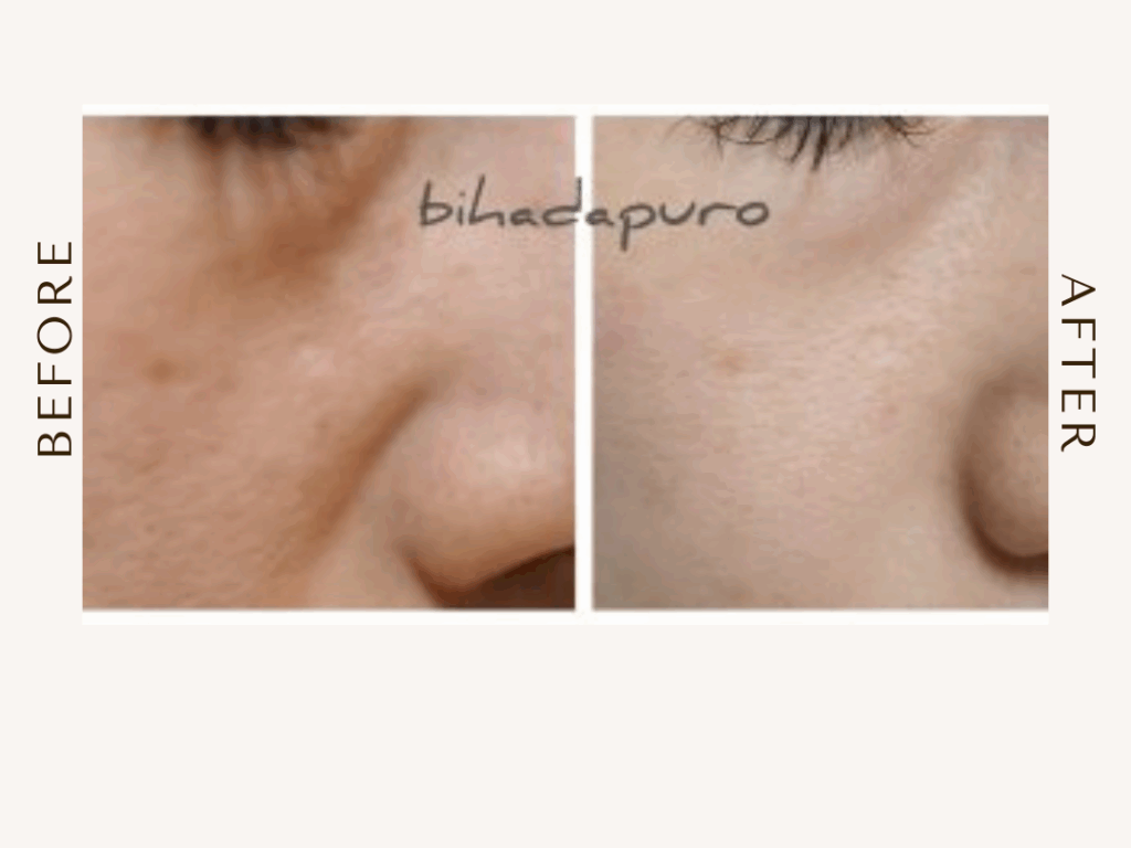 スピキュールケアをセル日でした人の比較写真