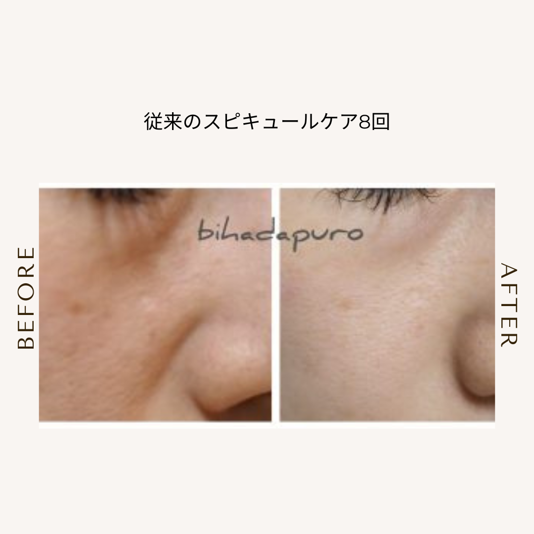 たるみ毛穴悩みにスピキュールケアをセル日でした人の比較写真