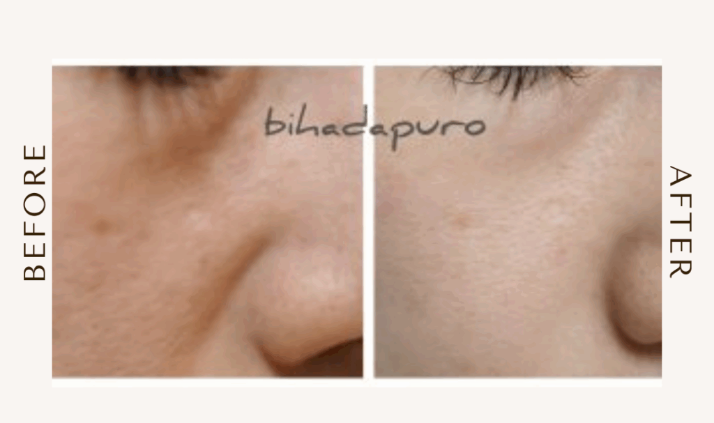 bihadapuroショップのスピキュールケアをセルフでした方のビフォーアフター