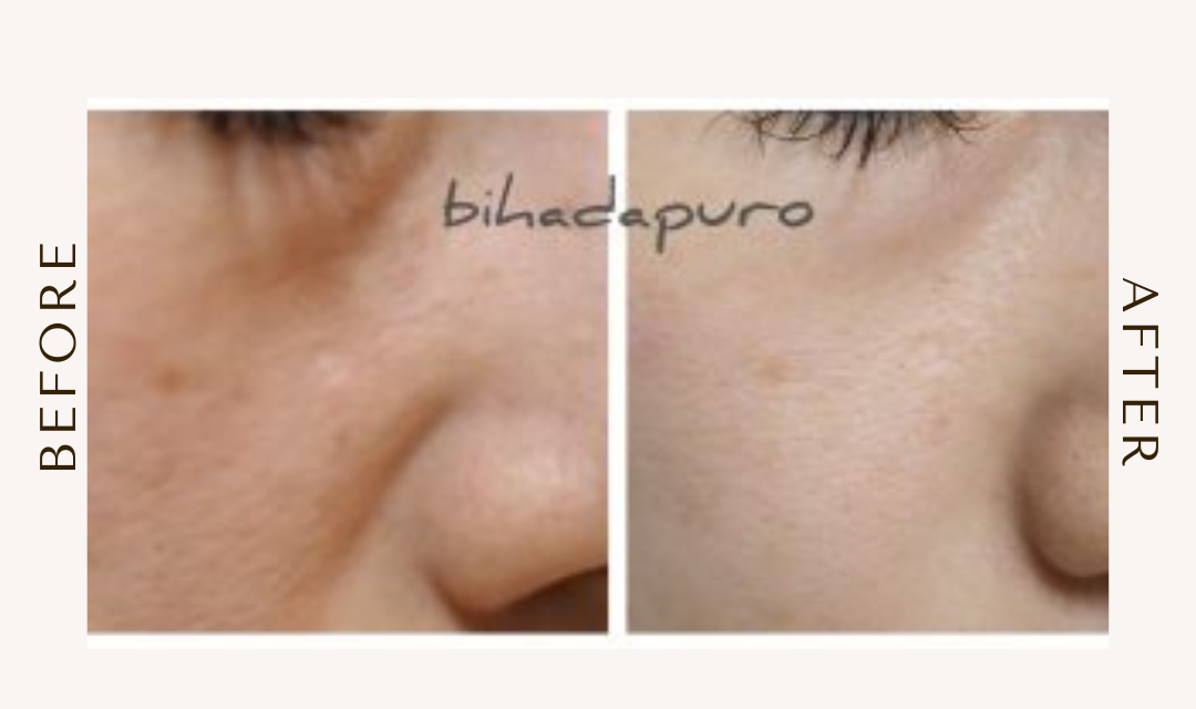 bihadapuroショップのスピキュールケアをセルフでした方のビフォーアフター