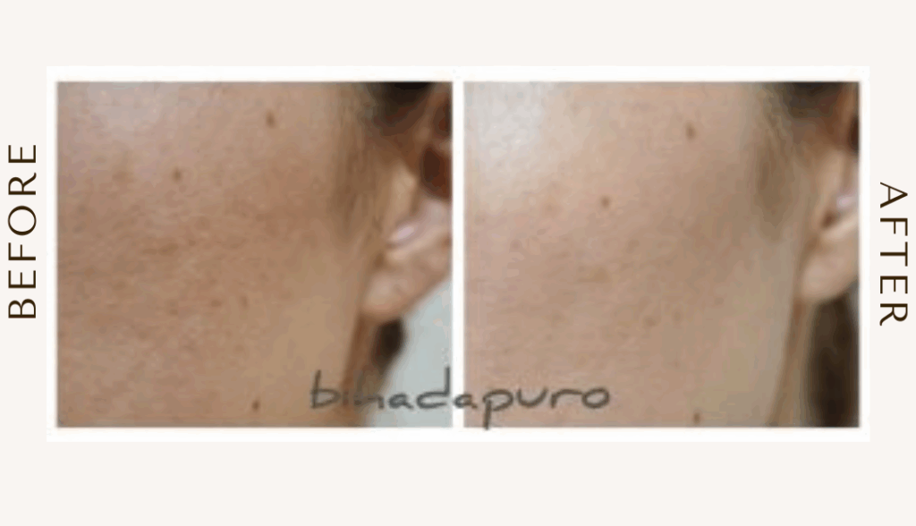 bihadapuroショップのスピキュールケアをセルフでした方のビフォーアフター