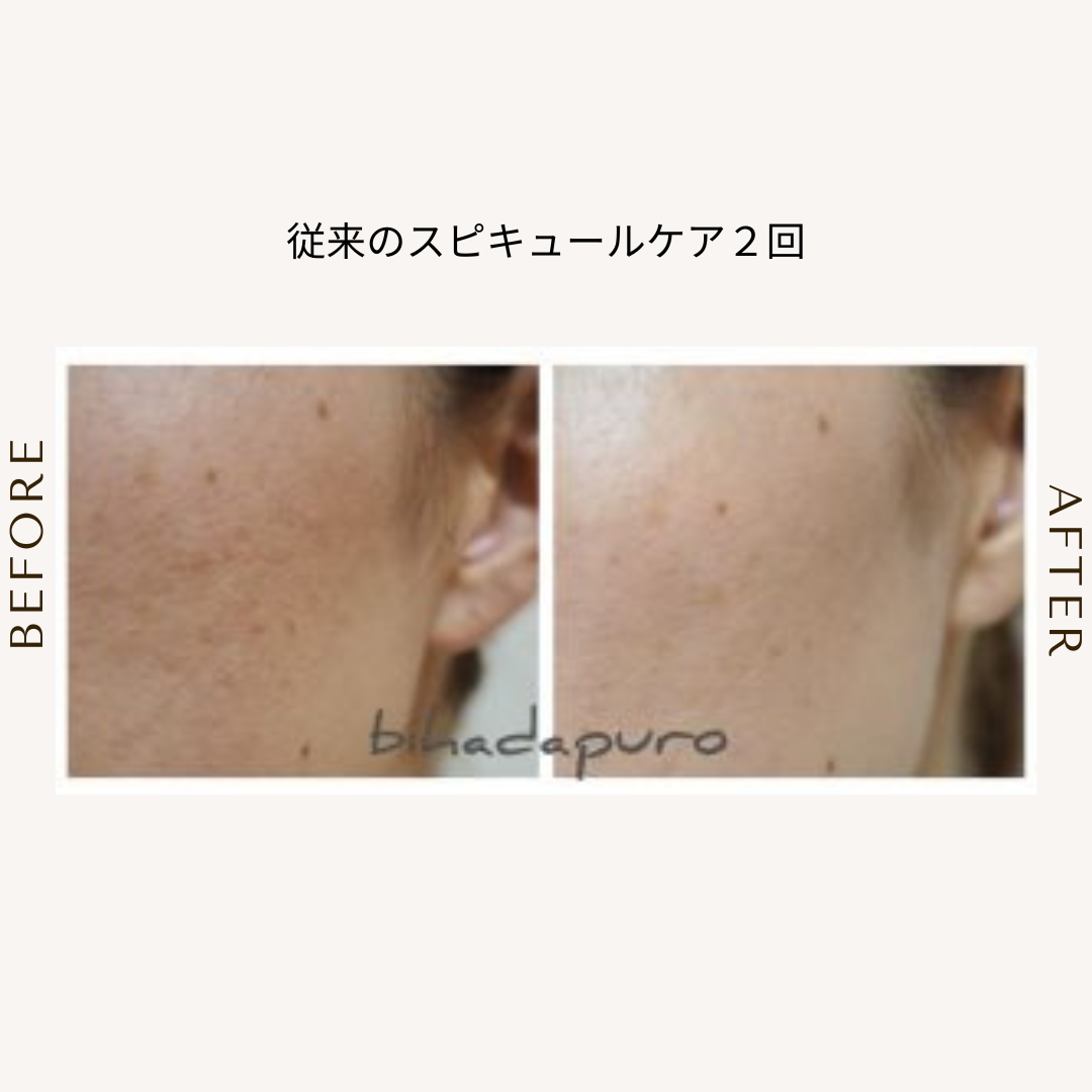 bihadapuroショップのスピキュールケアをセルフでした方のビフォーアフター