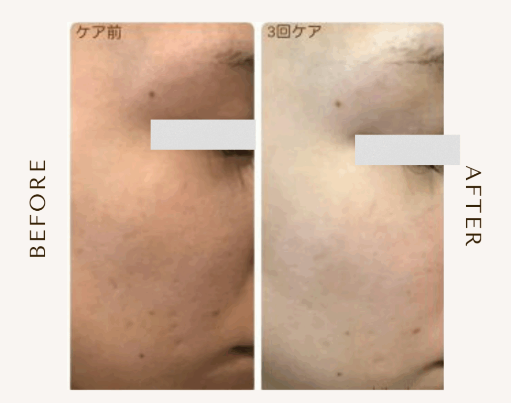 bihadapuroショップのスピキュールケアをセルフでした方のビフォーアフター