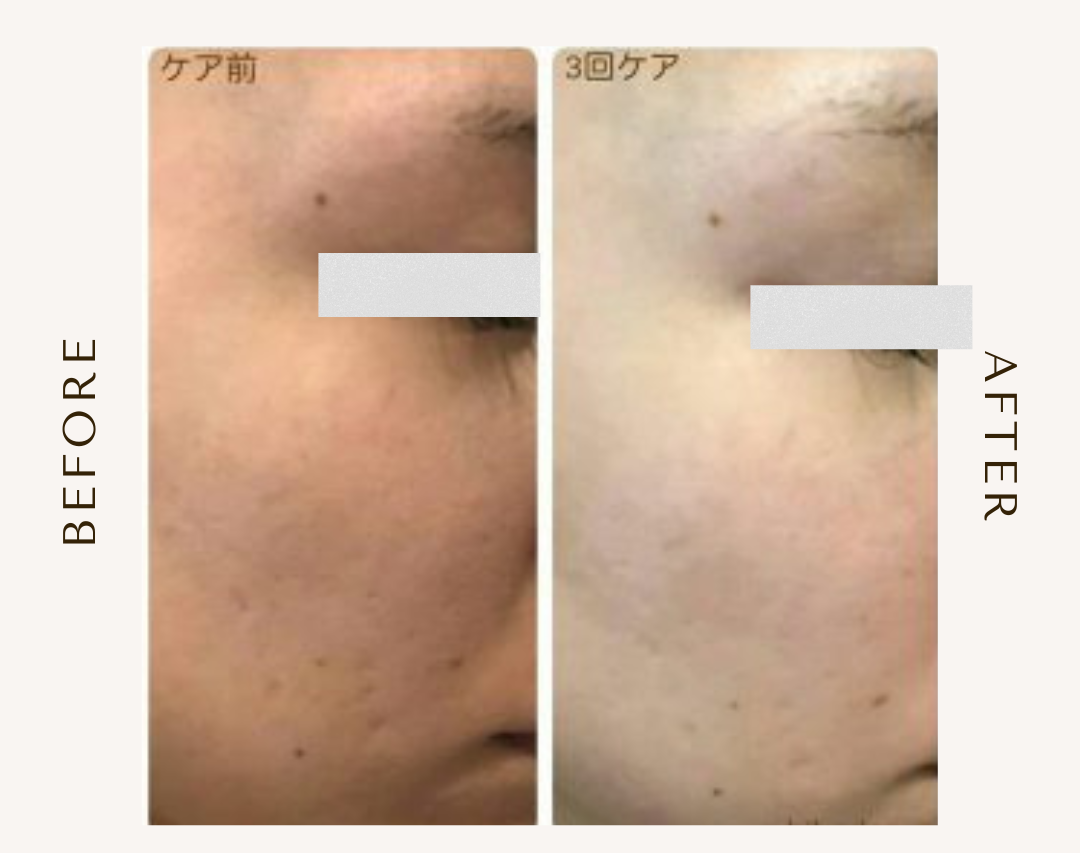 bihadapuroショップのスピキュールケアをセルフでした方のビフォーアフター