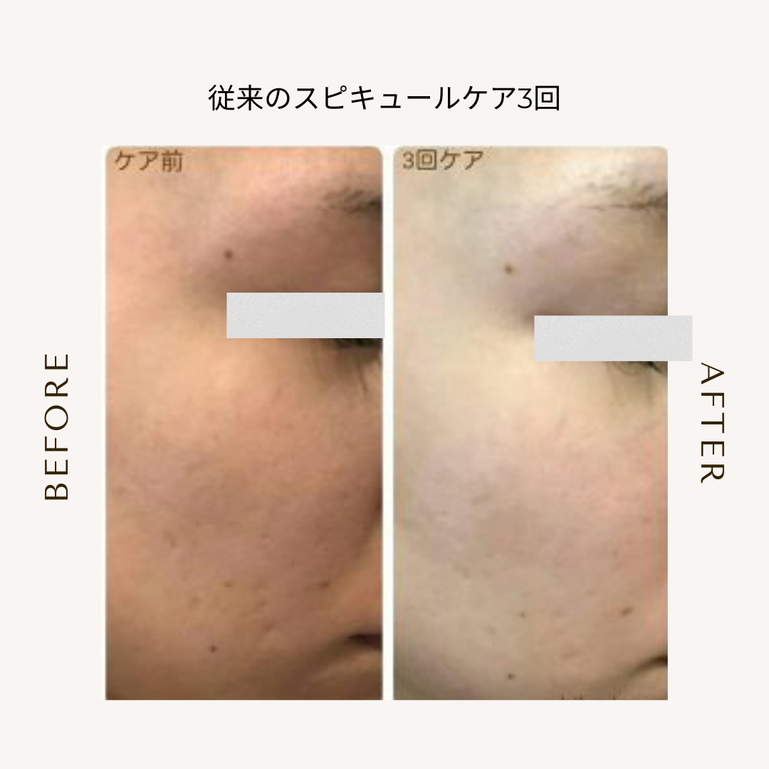bihadapuroショップのスピキュールケアをセルフでした方のビフォーアフター
