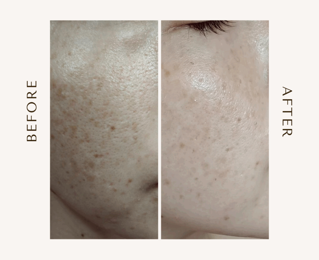 bihadapuroショップのスピキュールケアをセルフでした方のビフォーアフター