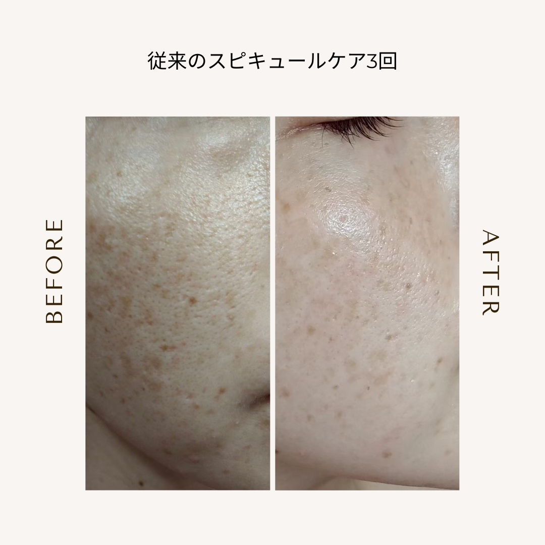 bihadapuroショップのスピキュールケアをセルフでした方のビフォーアフター