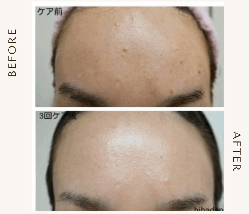 bihadapuroショップのスピキュールケアをセルフでした方のビフォーアフター