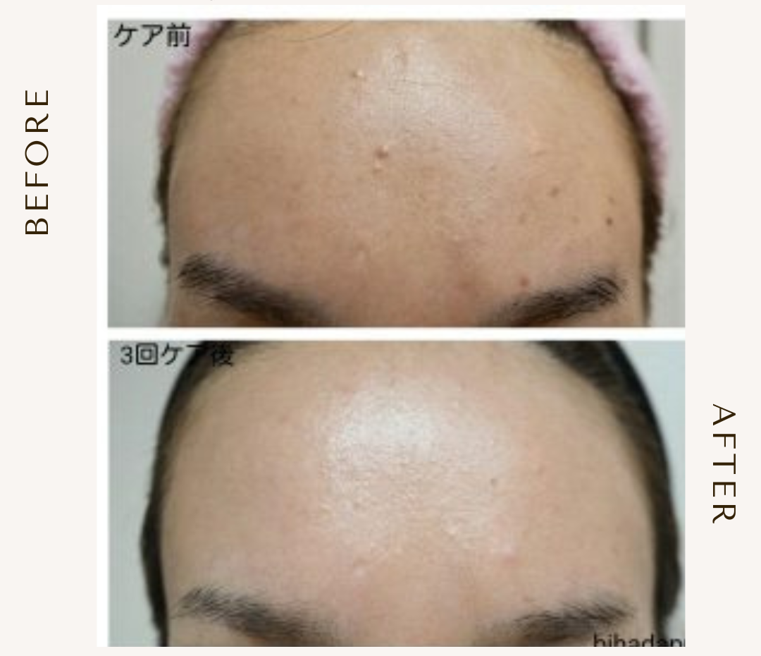 bihadapuroショップのスピキュールケアをセルフでした方のビフォーアフター