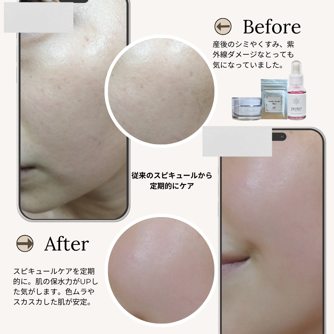 bihadapuroショップのスピキュールケアをセルフでした方のビフォーアフター