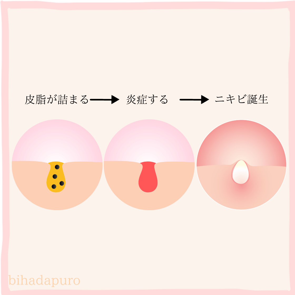 生理前のニキビができるサイクルのイメージ