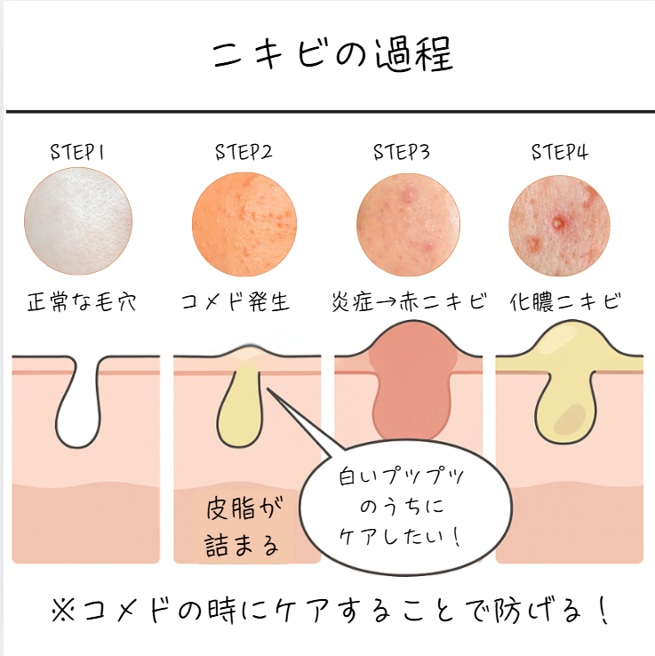 正常な毛穴からコメド発生、赤ニキビ、化膿ニキビへ進行する過程を示したイラスト図。白いプツプツのうちにケアすることの重要性を伝える
