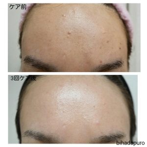 bihadapuroショップのスピキュールケアをセルフでした方の写真