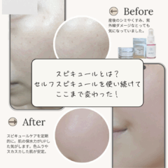 【Before/Afterあり】スピキュールとは？セルフスピキュールでここまで変わった！