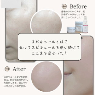 【Before/Afterあり】スピキュールとは？セルフスピキュールでここまで変わった！