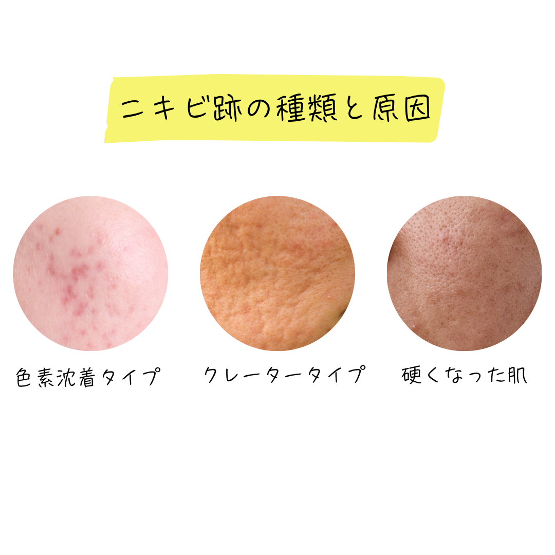 ニキビ跡の種類を画像でイメージしやすくまとめた