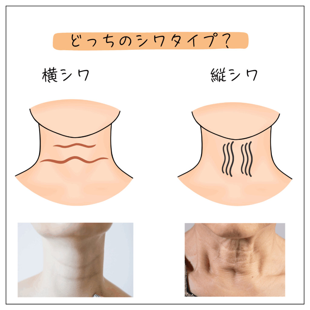 首のシワ、横じわと縦じわの比較イメージ