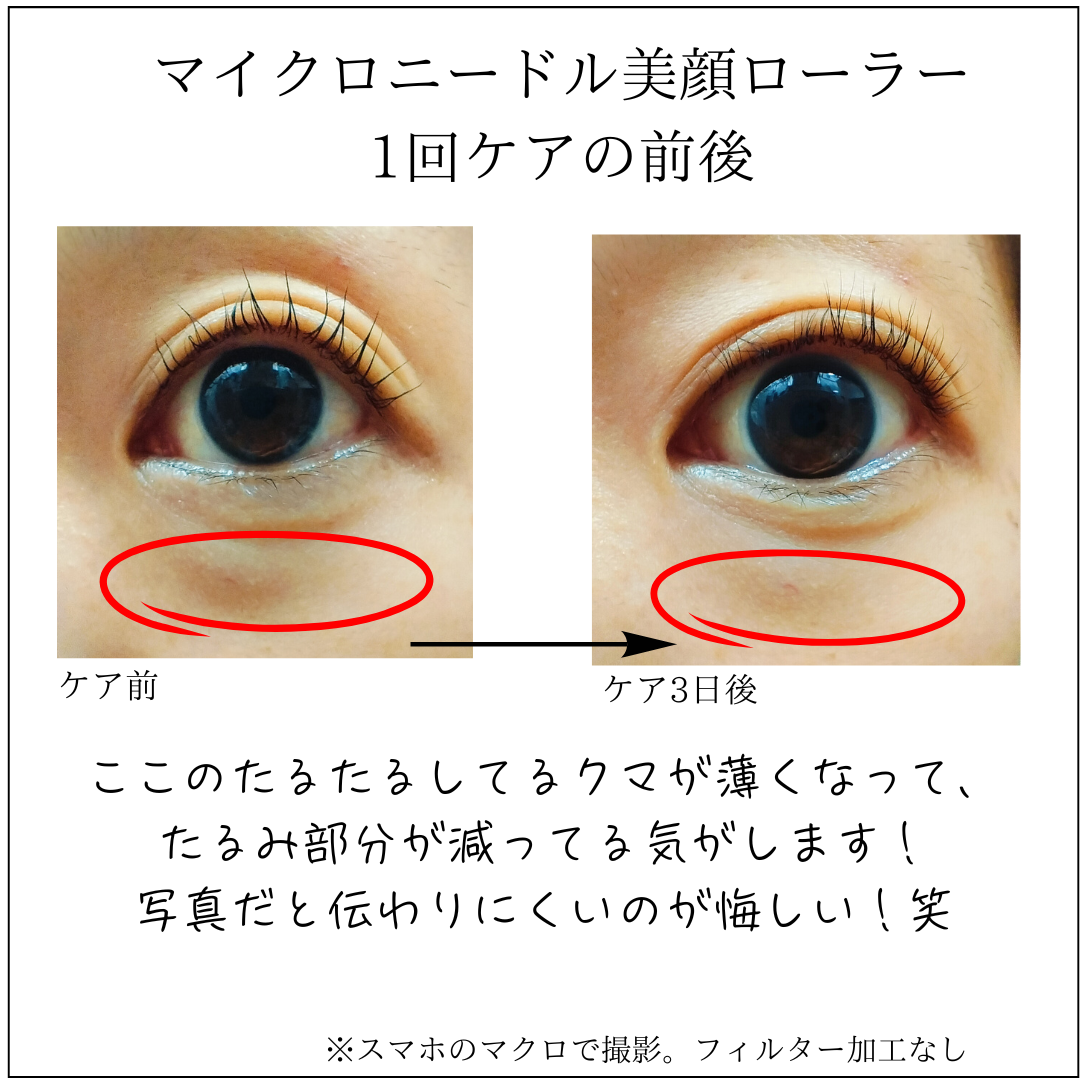 マイクロニードル美顔ローラーの目元ケアのビフォーアフター