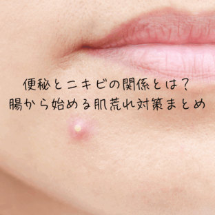 便秘とニキビの関係とは?腸から始める肌荒れ対策まとめ