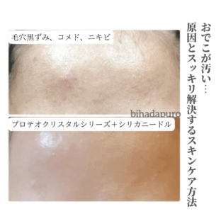 おでこが汚い…原因とスッキリ解決するスキンケア方法