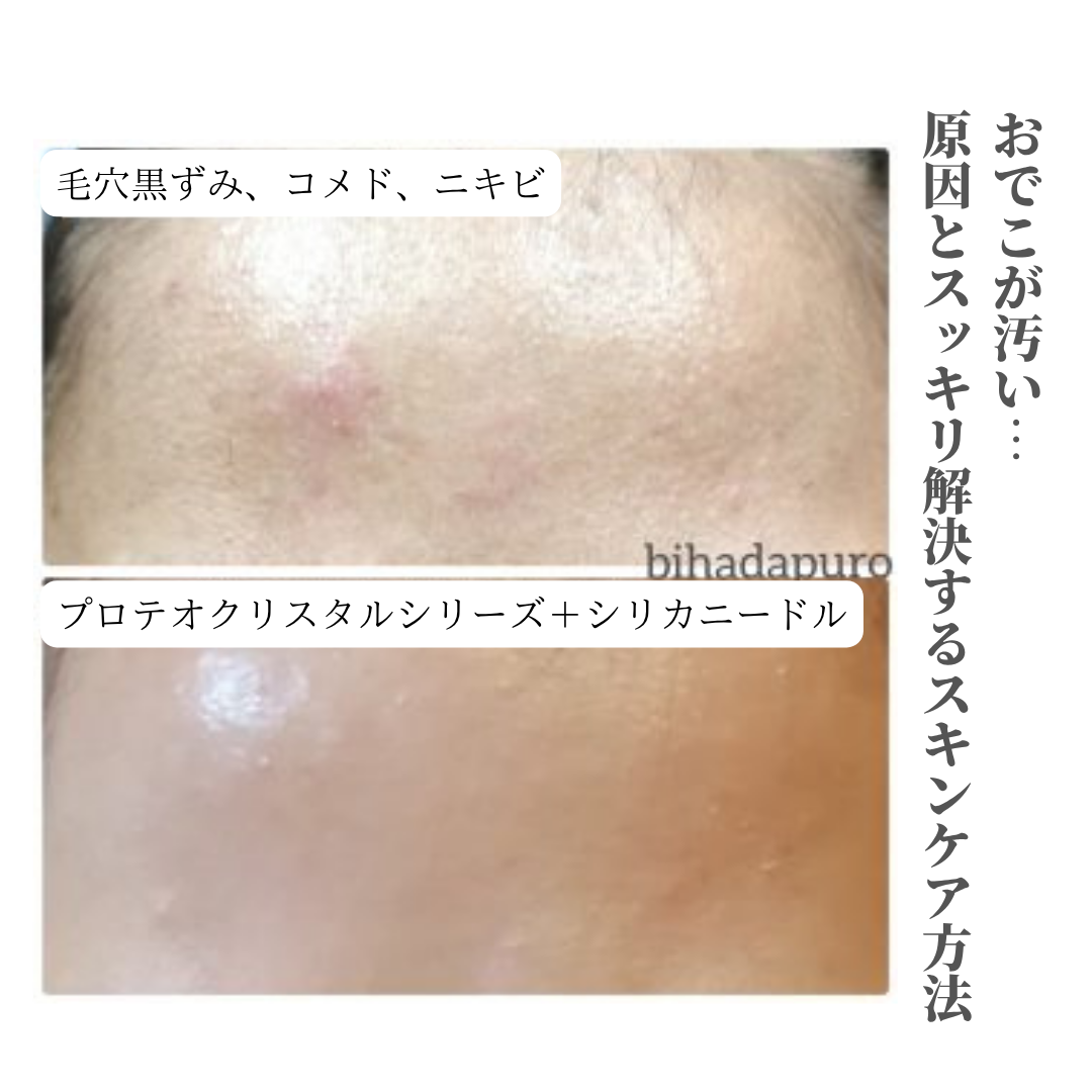 おでこが汚い… 原因とスッキリ解決するスキンケア方法