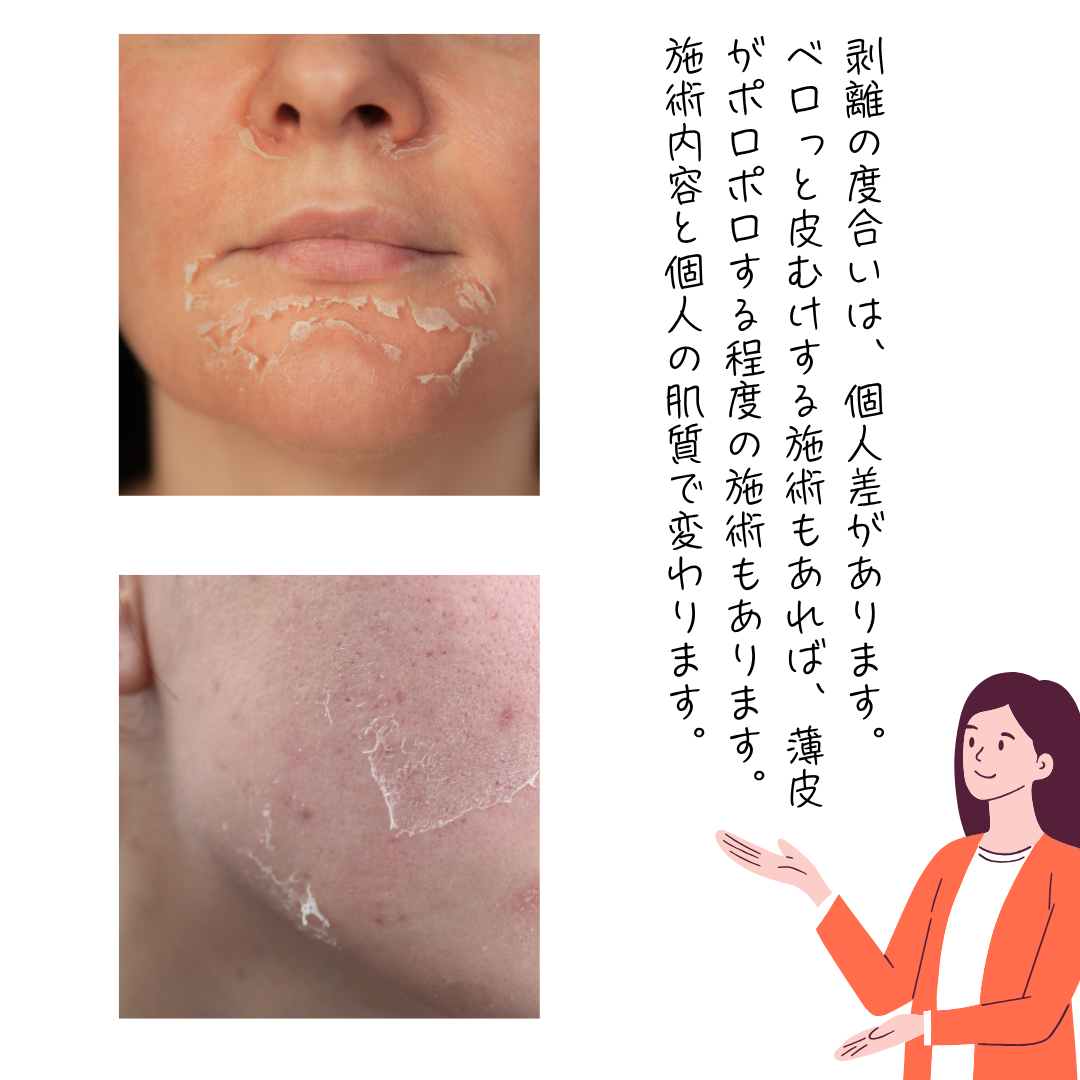 ハーブピーリングの皮膚剥離の程度の説明