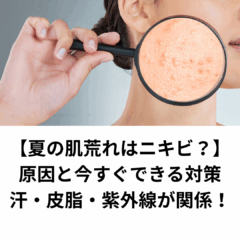 【夏の肌荒れはニキビ？】原因と今すぐできる対策｜汗・皮脂・紫外線が関係！