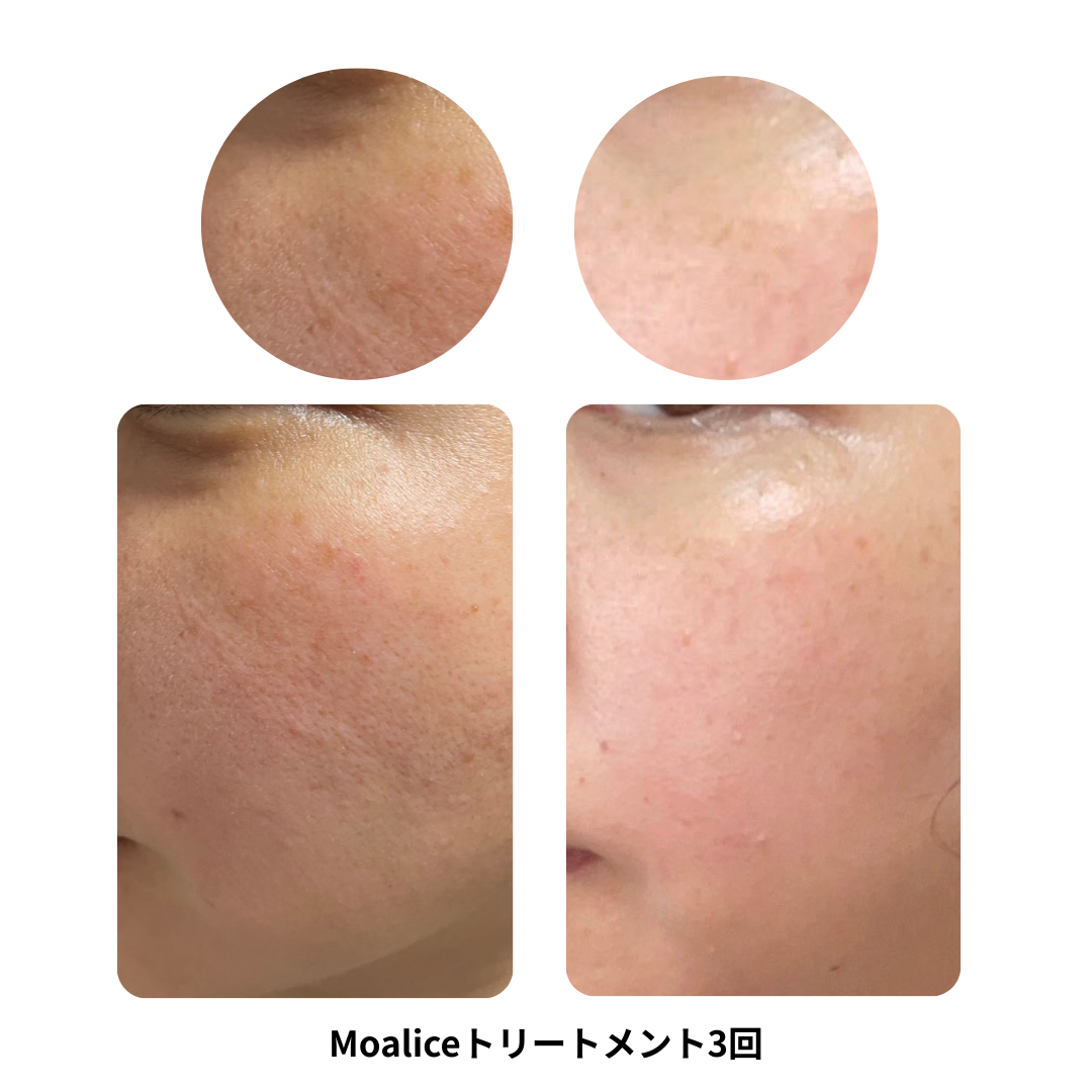 スピキュールケア3回ビフォーアフター