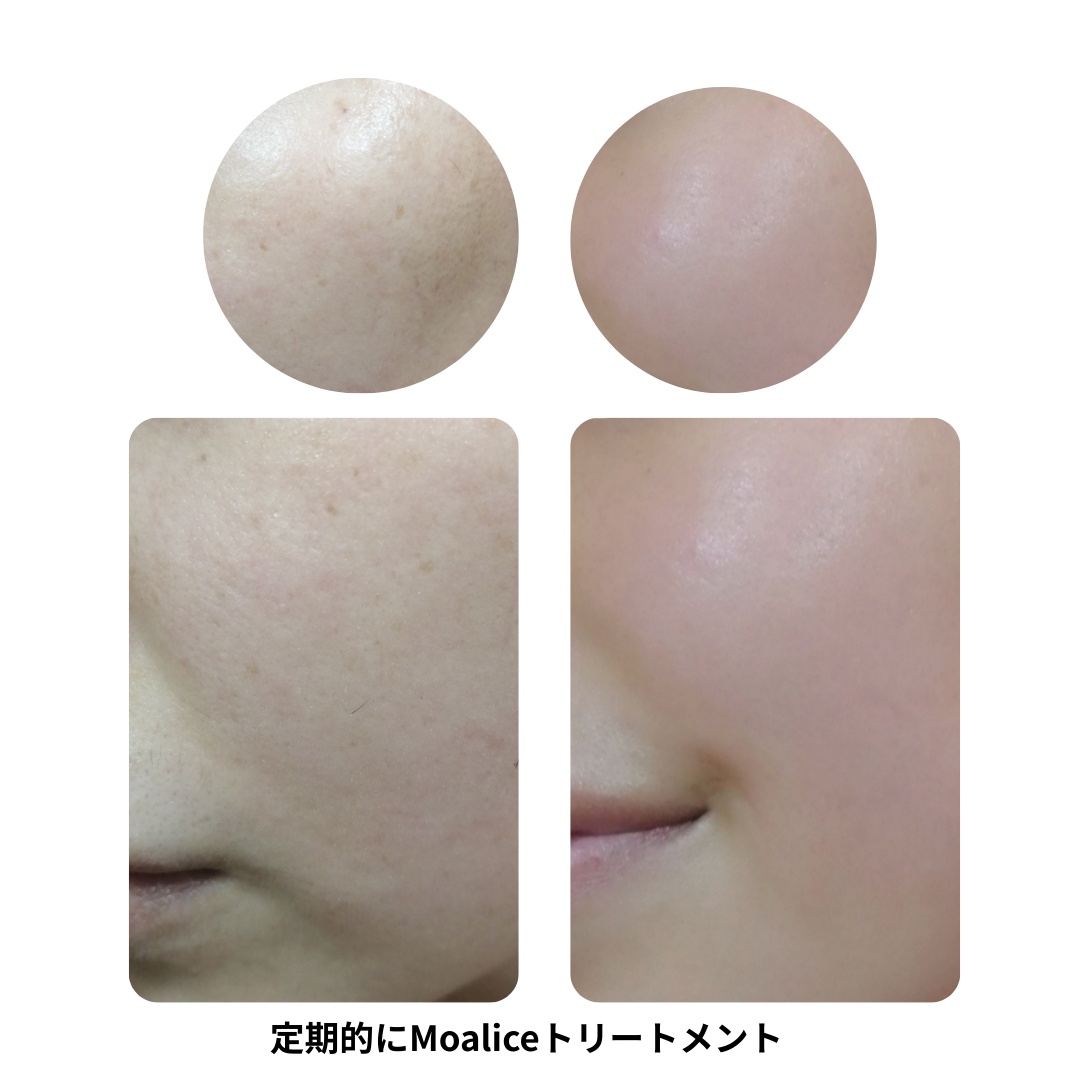 Moaliceトリートメント