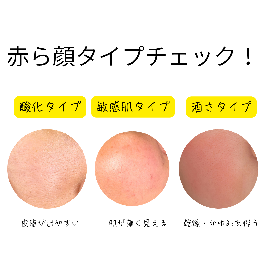 赤ら顔のタイプ3種類