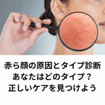 赤ら顔の原因とタイプ診断|あなたはどのタイプ?正しいケアを見つけよう