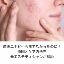 産後ニキビ…今までなかったのに!原因とケア方法を元エステティシャンが解説
